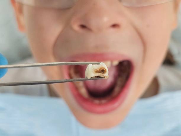 Best Emergency Dental Care for Abscessed Tooth in Ferndale, CA